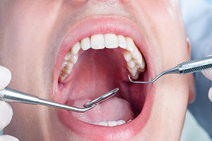 شیوع سرطان دهان به علت مصرف سیگار و قلیان/ بهداشت دهان و دندان را جدی بگیرید