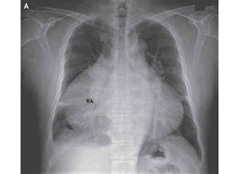 قلبی غول‌پیکر را در سینه مرد ۵۷ ساله ببینید/اشغال ۸۲ درصد از فضای عرضی قفسه سینه