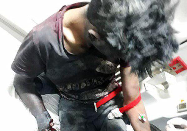 انفجار مواد محترقه در اصفهان دست یک نوجوان را قطع کرد